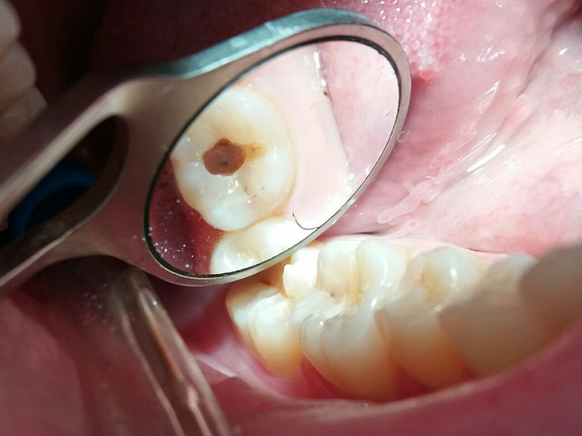 Кариес зубов - причины, лечение, профилактика